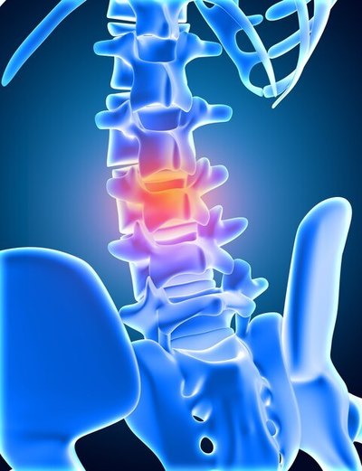 Herniated and bulging spinal discs